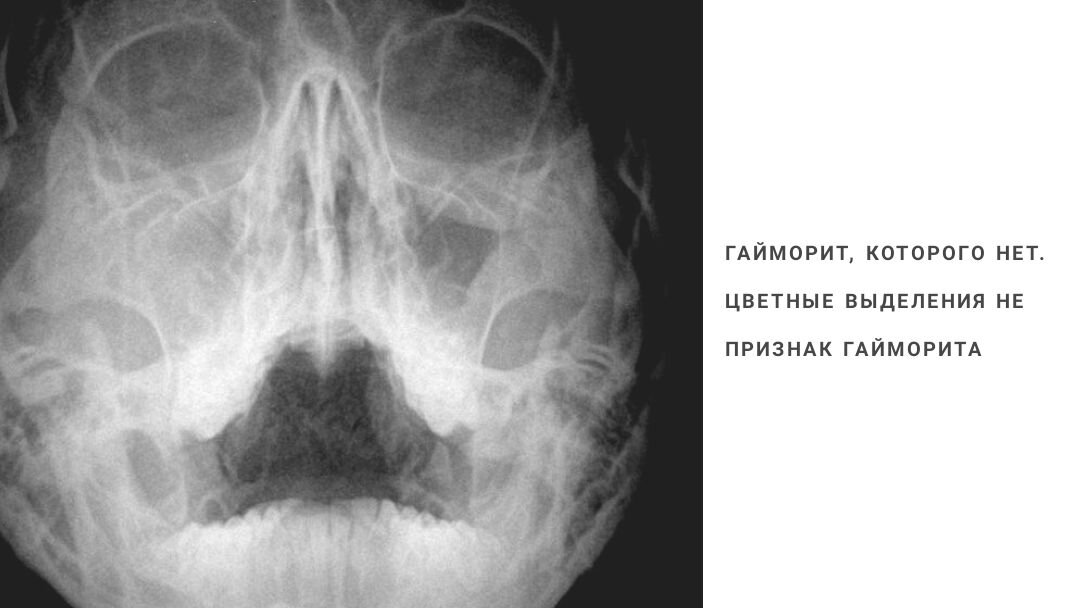 Гайморовы пазухи фото расположение схема