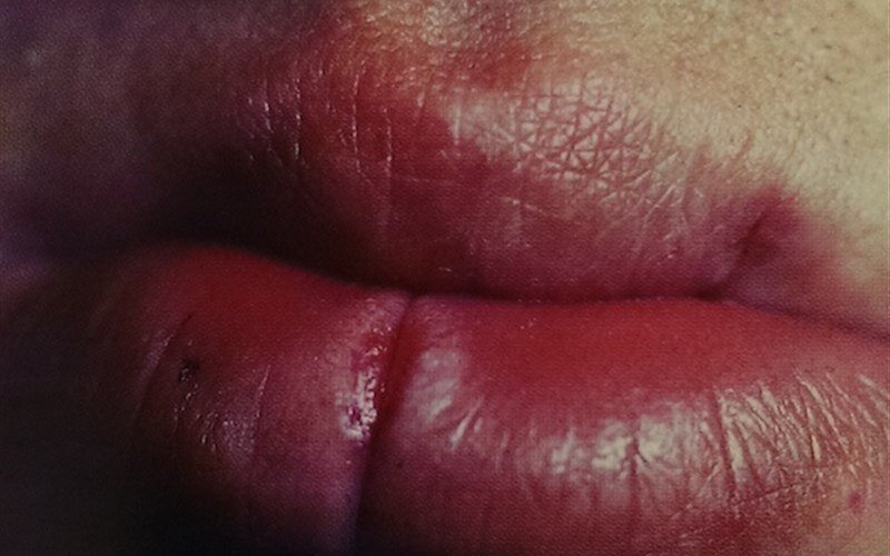 Трещина губы