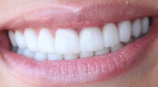 Методы установки виниров