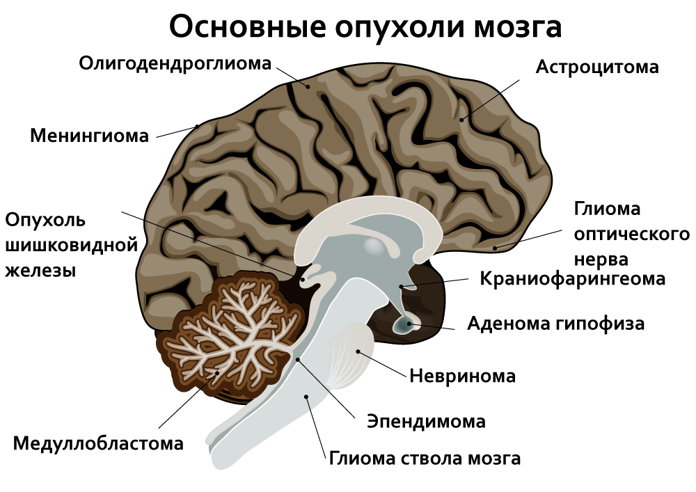 Объемное образование мозга код. Локализация опухолей головного мозга. Виды вторичных опухолей головного мозга. Первичные симптомы опухолей головного мозга. Объемное образование мозга.