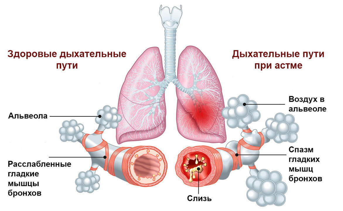Формы бронхиальной астмы