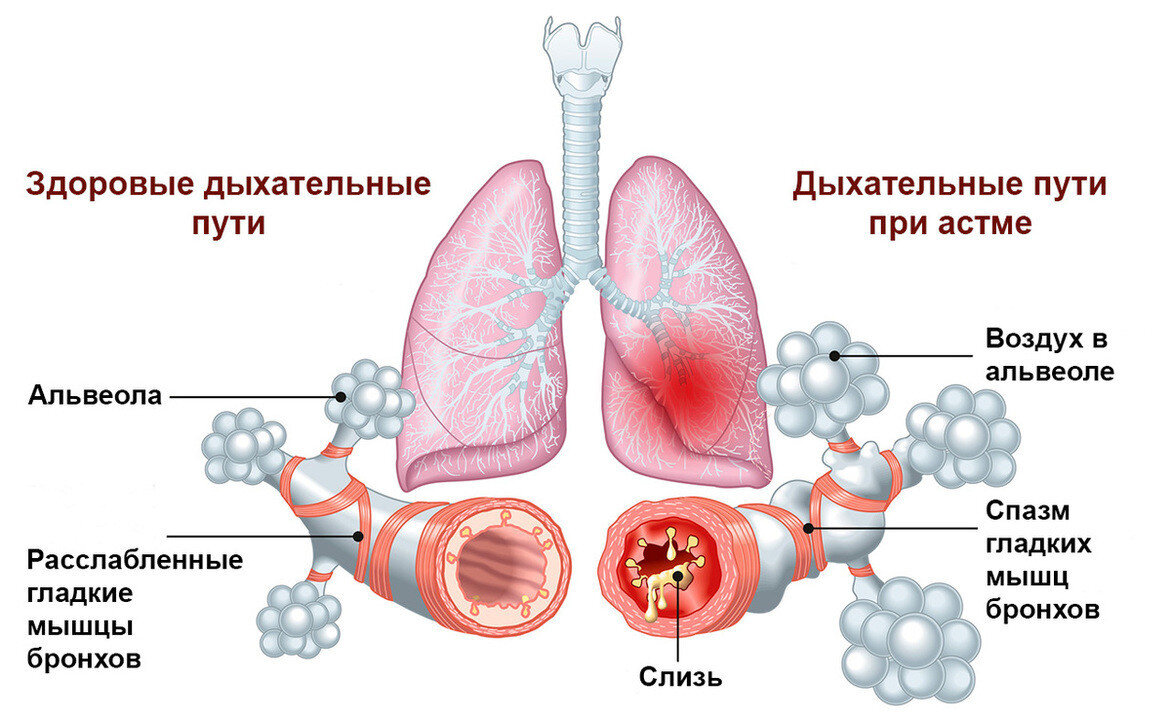 Лечение бронхиальной астмы картинки