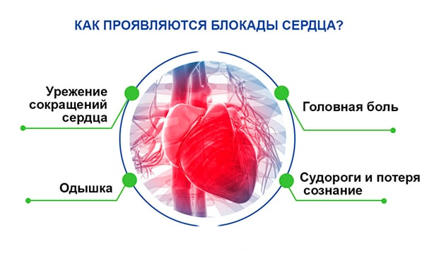 Сердце блокада левой. Блокада сердца. Проявления блокады сердца. Блокады сердца кратко. Виды блокад сердца.