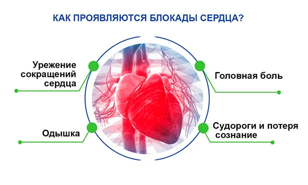 Блокада левого у сердца