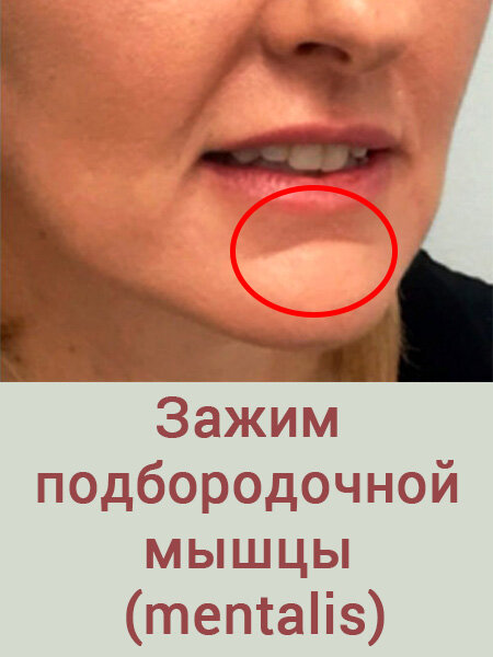 Зажим подбородочной мышцы (mentalis)