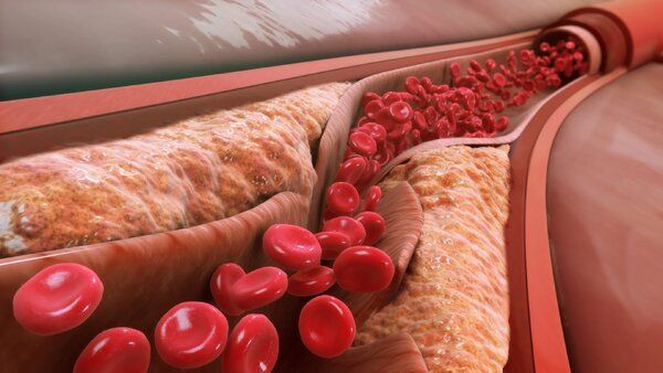 Низкий холестерин может вызвать инсульт, а разжижжение крови аспирином желудочное кровотечение