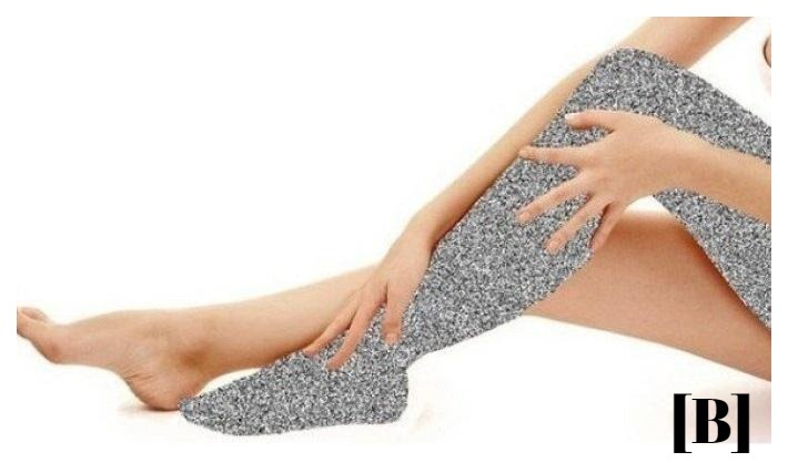 Отсиженная нога