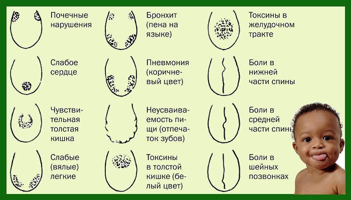 Откуда на языке налёт: причины, последствия, рекомендации стоматолога