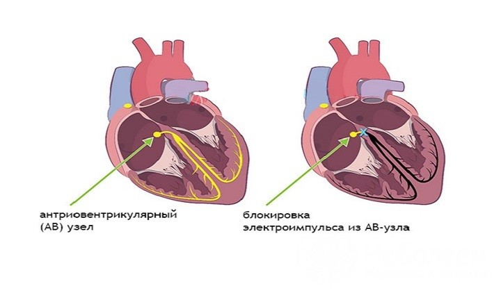 Лечение атриовентрикулярных (АВ) блокад 1, 2 и 3 степени