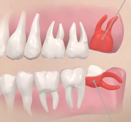 Разное расположение зуба мудрости 