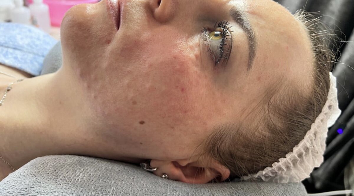 Биоревитализация лица