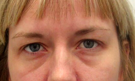 Каплевидная форма нижнего века