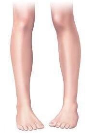 косолапость