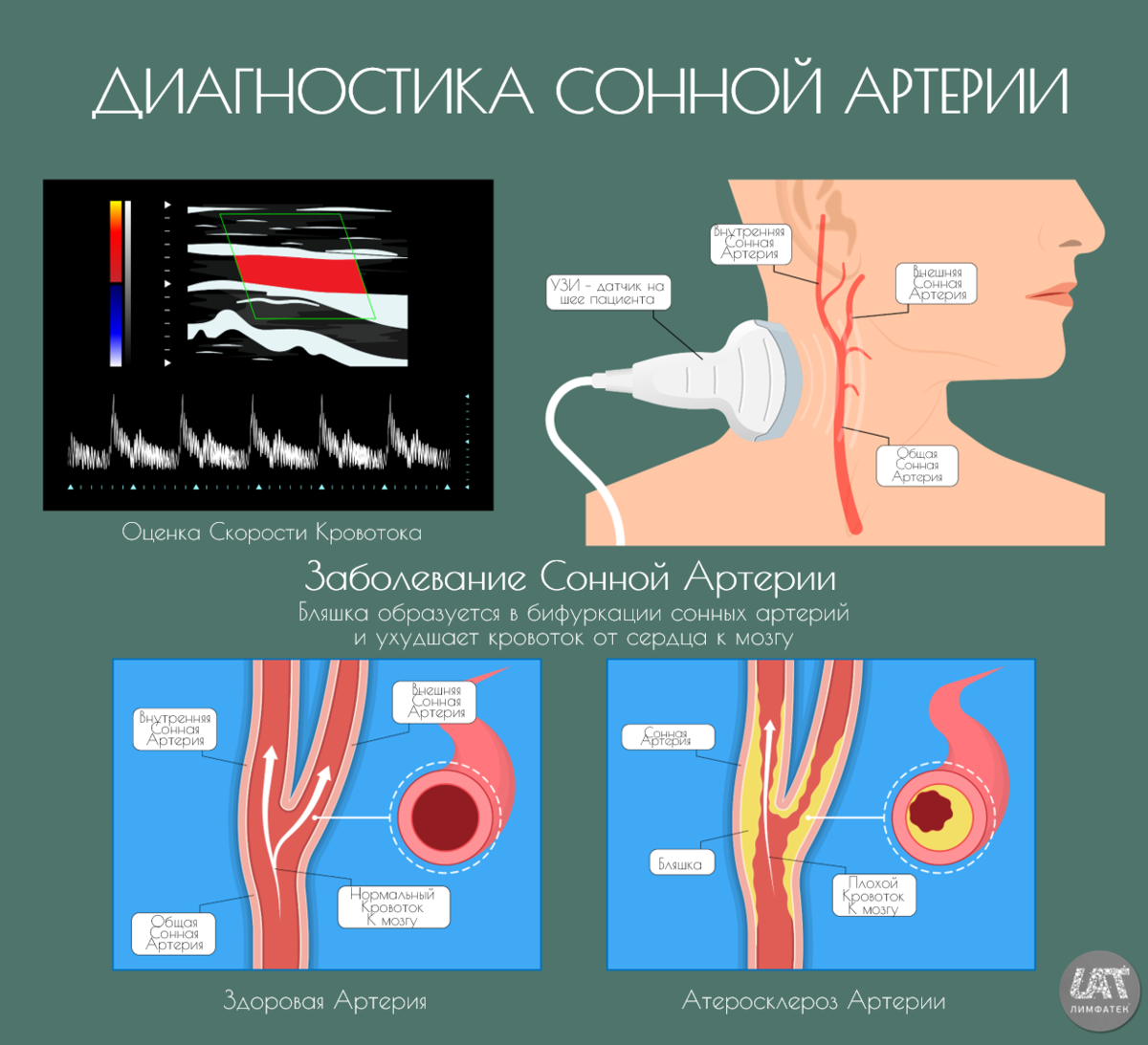 Атеросклероз экстракраниального отдела брахиоцефальных артерий. Атеросклероз сосудов сонных артерий. Атеросклеротическая бляшка в сонной артерии. Атеросклеротическое сужение сосудов.