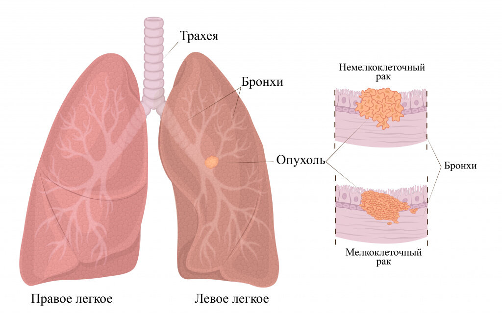 Отличиться легкого. Атипичная резекция легкого. Немелкоклеточная карцинома легкого.