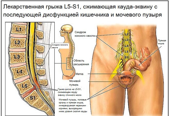 Что такое синдром конского хвоста и как с ним бороться.