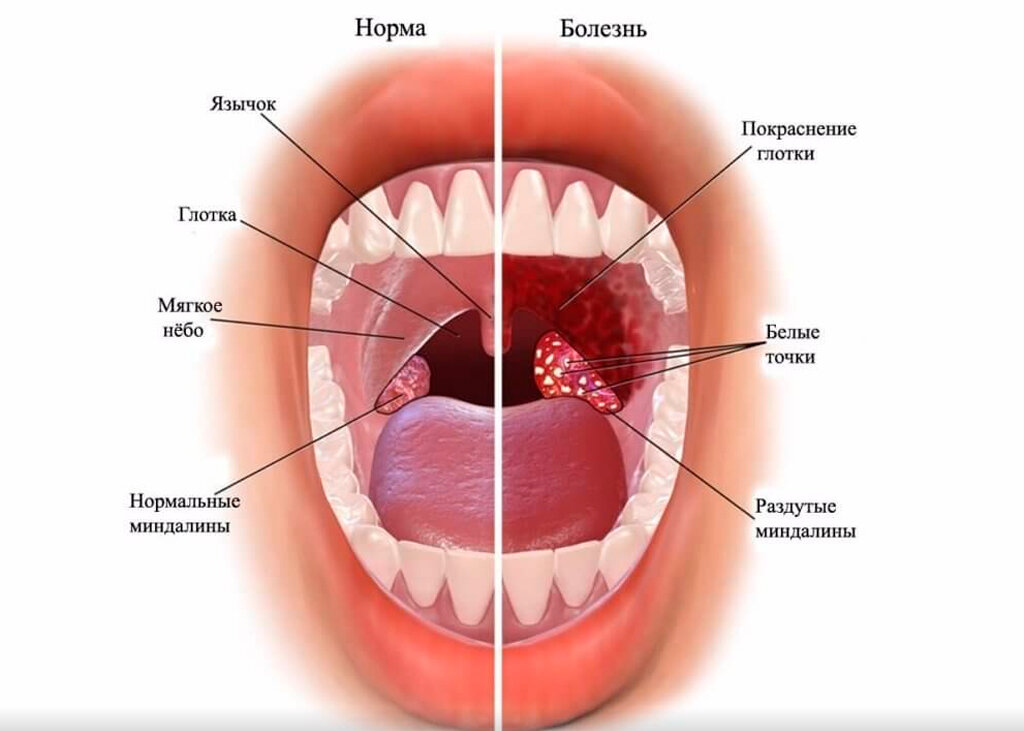 Лечение ангины у детей