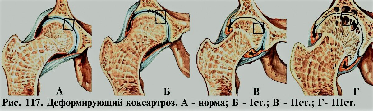 Степени коксартроза. Фото из интернета.