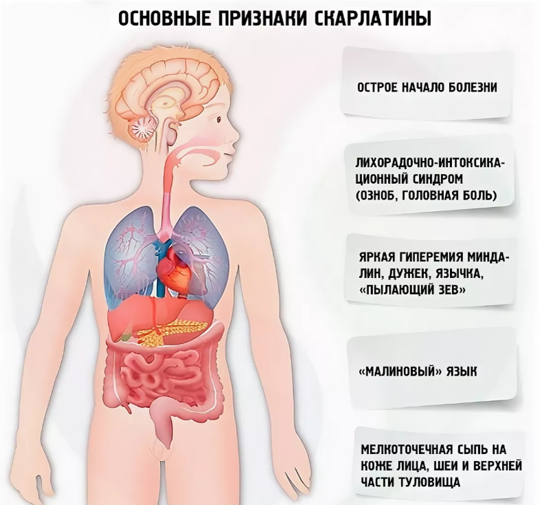 4 главных симптома скарлатины