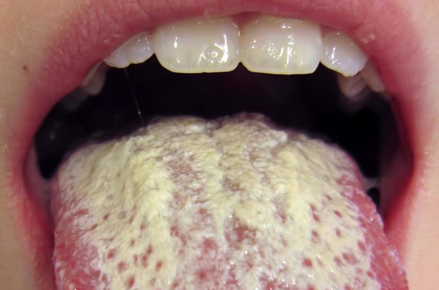 Так выглядит грибок на языке. Фото: Яндекс.Картинки