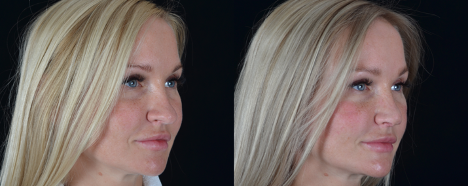 На фото: ринопластика кончика носа, фото с сайта клиники «Доктора Гришкяна».