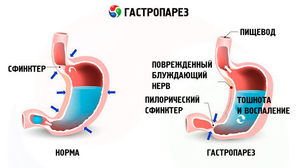 Гастропарез желудка. Гастропарез при сахарном диабете. Идиопатический гастропарез.