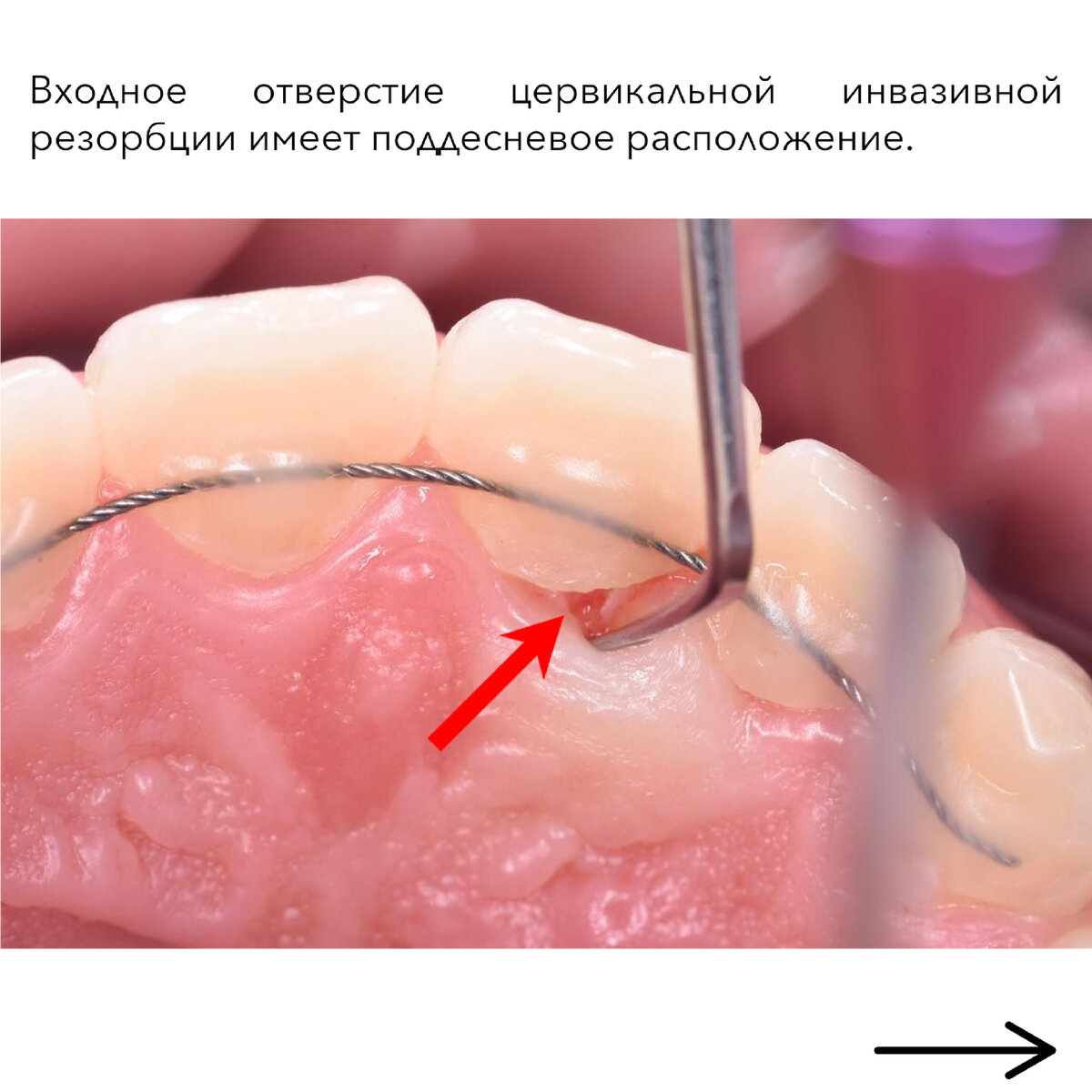 Резорбция корня зуба – что это такое