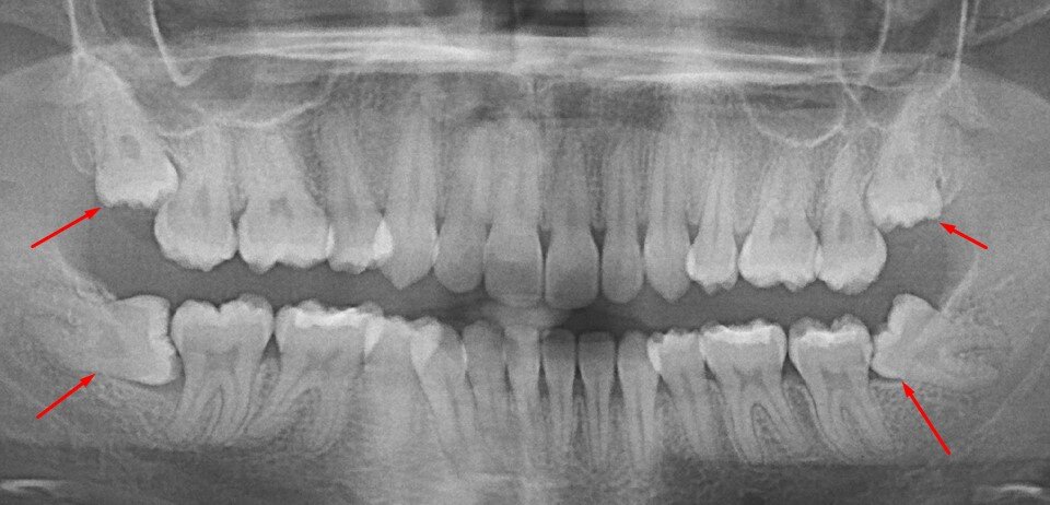 Миф 3: Зубы мудрости приводят к смещению остальных зубов