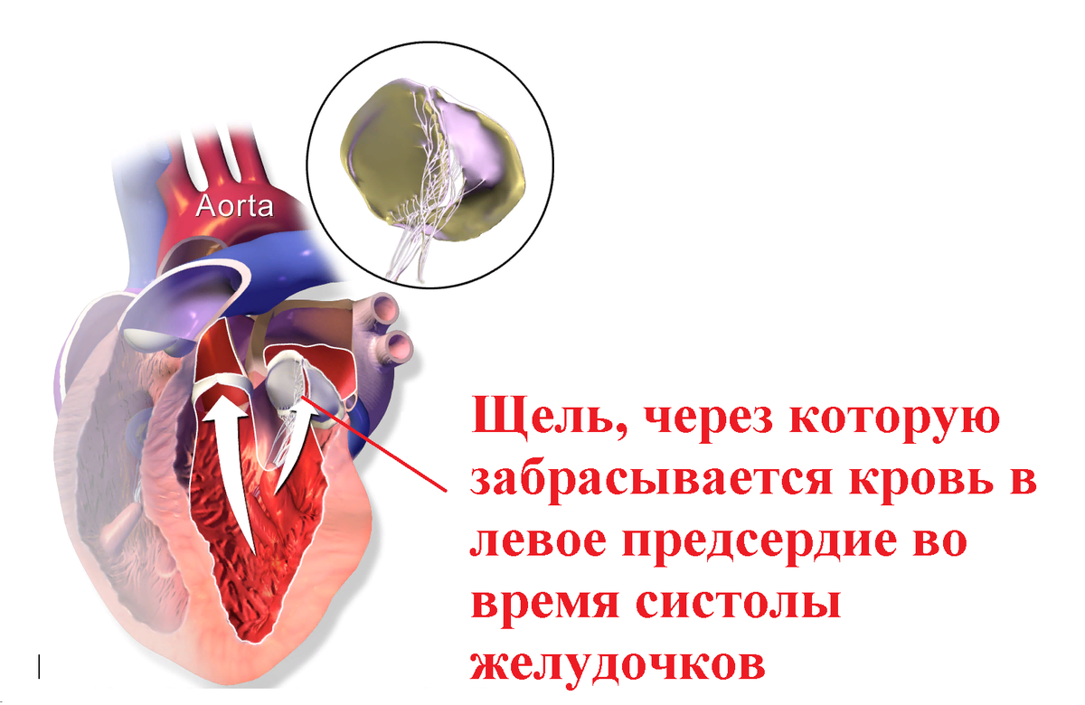 Пролапс митрального клапана у женщины. Митральная недостаточность 1-2 степени и пролапс митрального клапана. Пролапс митрального клапана 1 степени. Пролапс МК 1 степени. ПМК 1 степени с регургитацией.