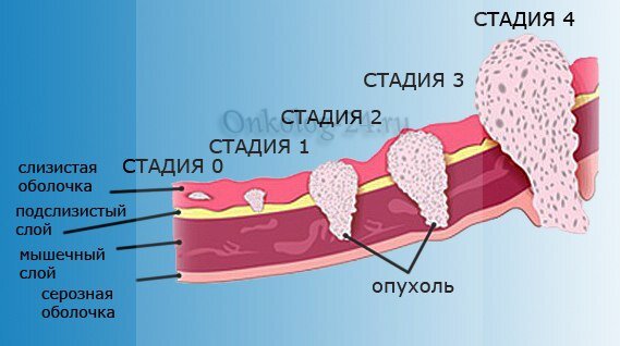 Как выглядит первая стадия рака