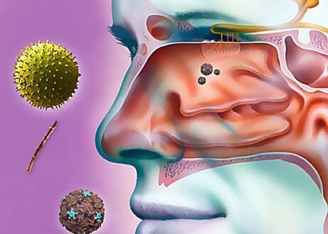 Аллергический гайморит