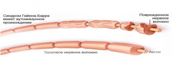 Синдром барре у детей. Синдром Гийена Барре патогенез. Синдром Гийена Барре этиология. Болезнь синдром Гийена Барре. Демиелинизирующая полинейропатия Гийена Барре.
