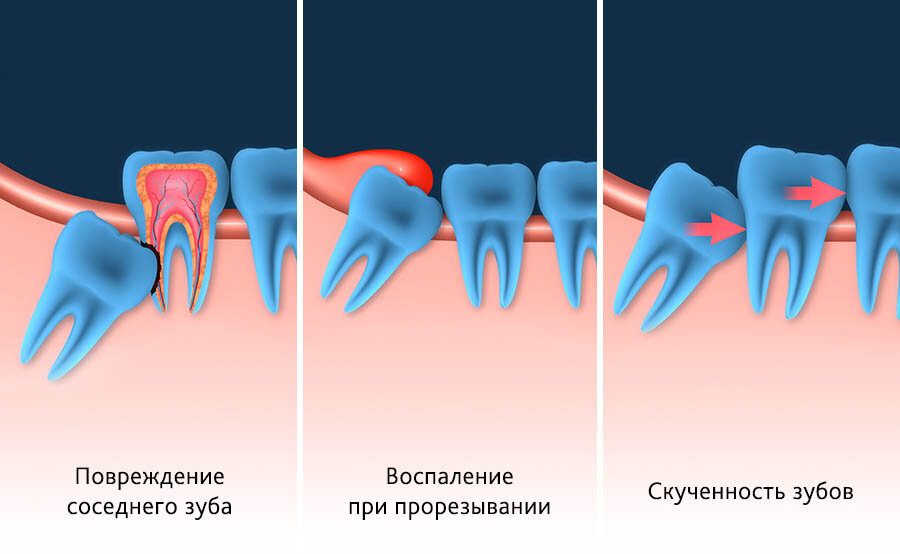  Причины для удаления зуба мудрости 