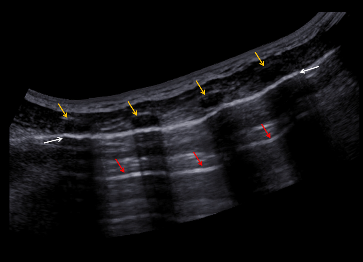 Рис. 2A. На панорамном ультразвуковом изображении видна стенка грудной клетки и плевра (ребра: желтые стрелки, плевра: белые стрелки). А-линии это яркие горизонтальные линии глубже плевральной линии (красные стрелки). A-линии - классический артефакт реверберации.