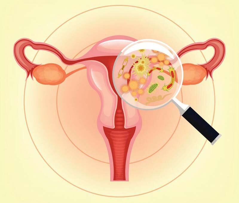 Бактериальный вагиноз — нарушение интимной гармонии в организме женщины