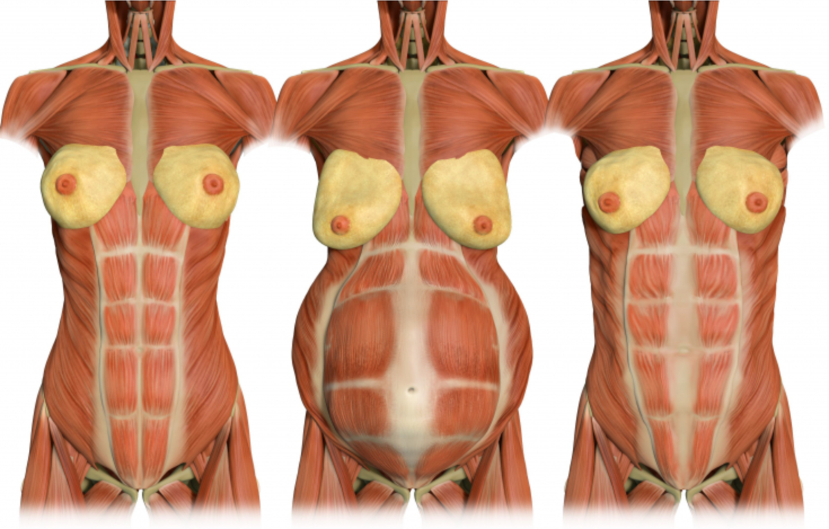 Мышцы живота после беременности. Диастаз прямой мышцы живота. Диастаз брюшной стенки.