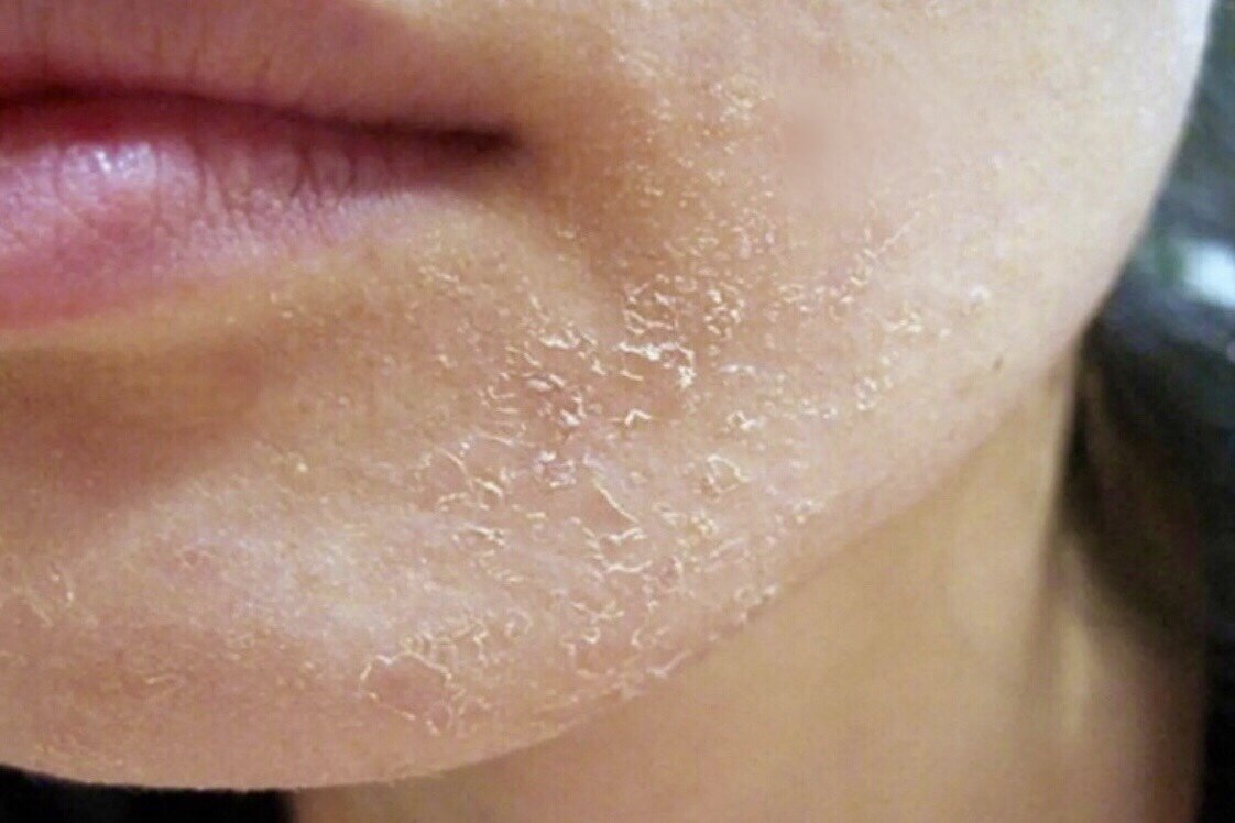 Шелушение кожи вокруг губ.