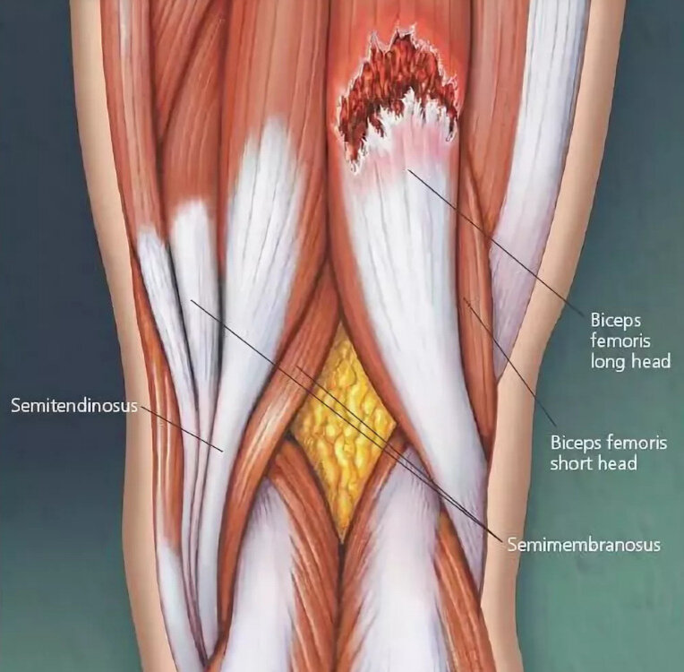 Операция на мышцах ног. Повреждение сухожилия четырехглавой мышцы бедра. Сухожильный трансплантата hamstring. Надрыв четырехглавой мышцы бедра. Отрыв сухожилий хамстринг.