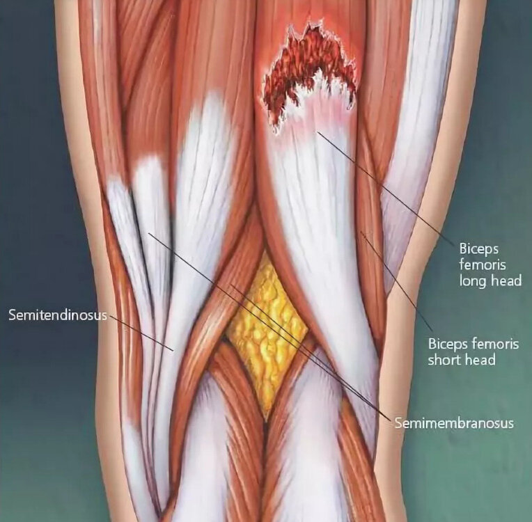 Повреждение сухожилия четырехглавой мышцы бедра. Сухожильный трансплантата hamstring. Надрыв четырехглавой мышцы бедра. Отрыв сухожилий хамстринг.