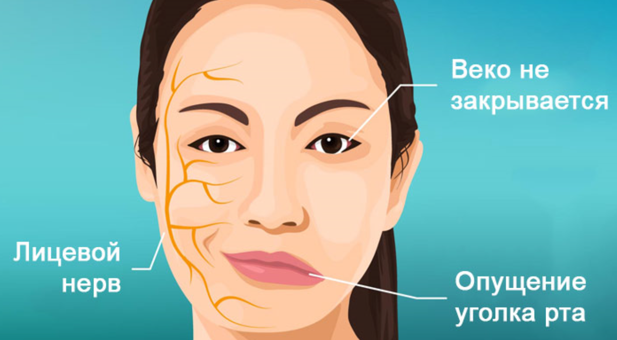 Вот тут хорошо понятно, как проходят ветви лицевого нерва. Конечно, в реале все выглядит далеко не так симпатично, как на картинке. При улыбке улыбается только здоровая часть лица. Язык тоже  уходит в сторону. Глаз не  закрывается, нижнее веко отвисает. Позже правая часть лица, которая в тонусе, начнет перетягивать на себя левую, пораженную параличом. Расслабленные мышцы без сигналов от лицевого нерва не могут "держать лицо" и вся физиономия "плывет на бок".