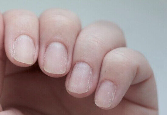 Finding and Fighting the Fungi in the Nails - YouTube