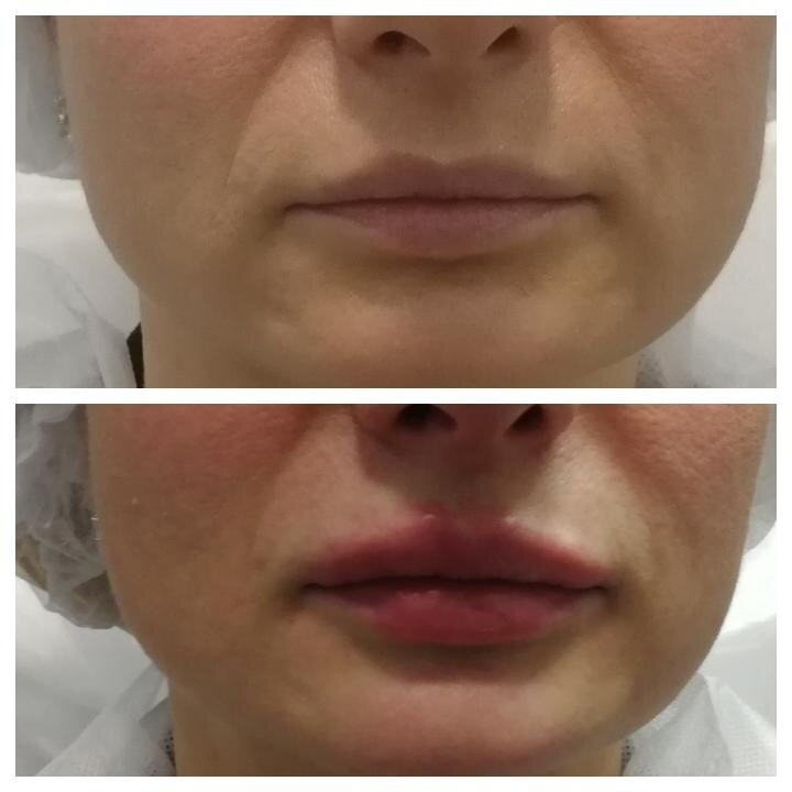 Красивые губы, контурная пластика. 