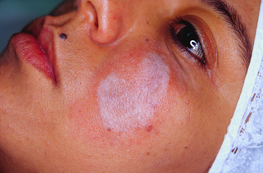 Так выглядит "фрост-эффект".