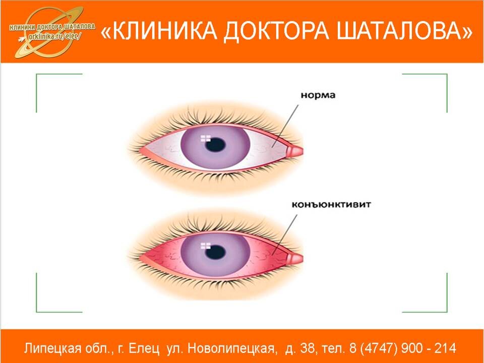 Конъюнктивит карта вызова скорой