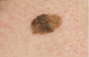 Старческая кератома