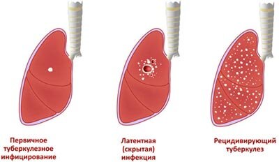 Симптомы и лечение туберкулеза