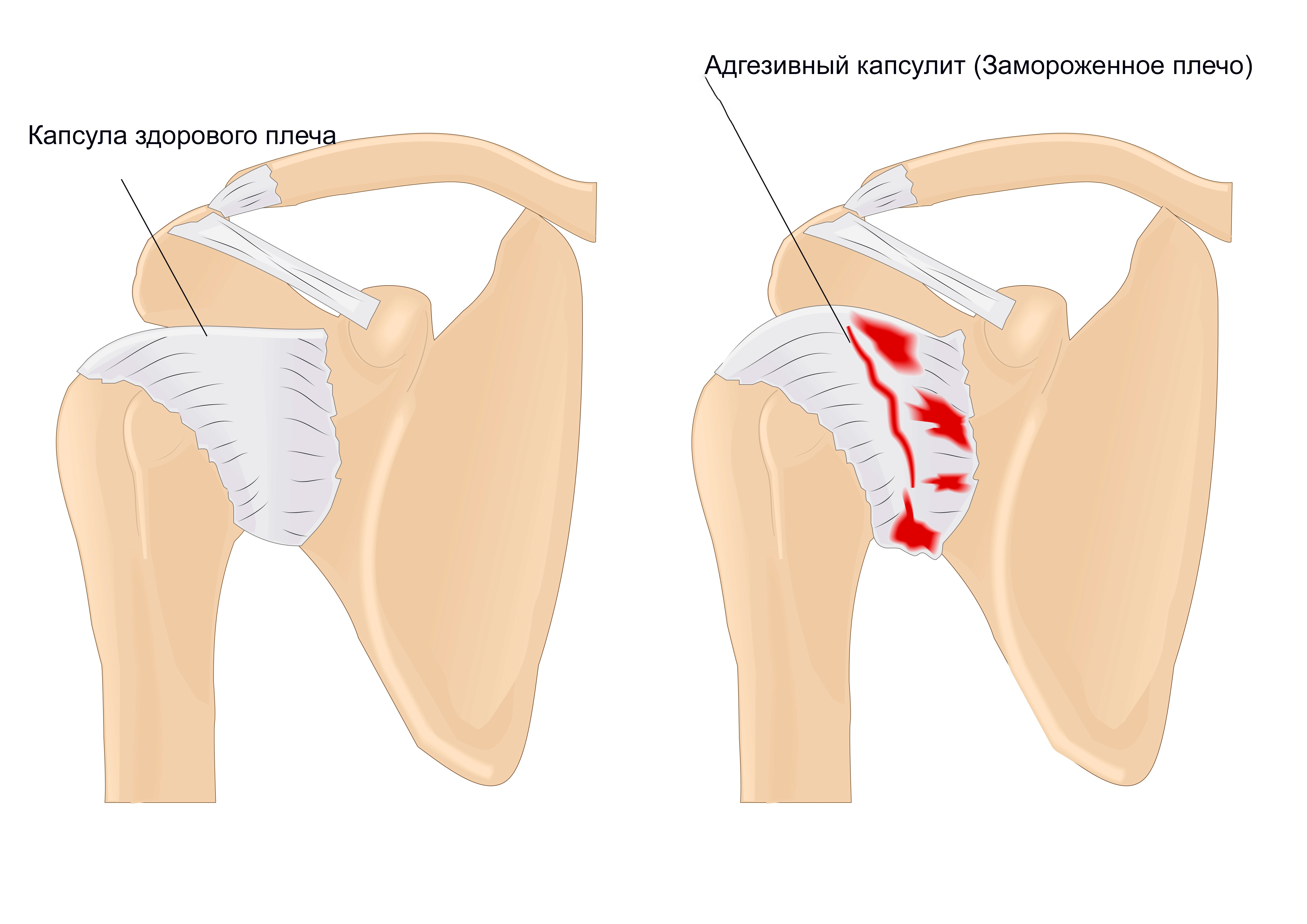 Адгезивный капсулит плеча фото