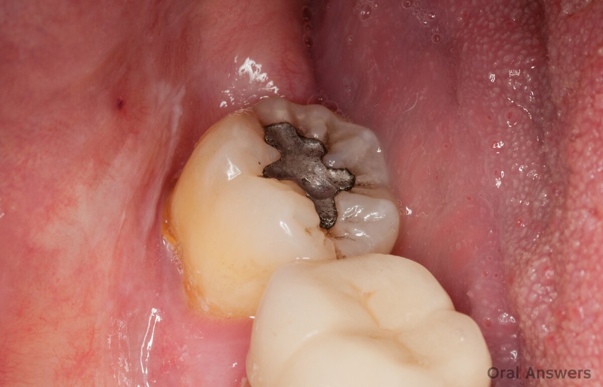 Да, страшненькие эти пломбы внешне, зато стоят десятилетиями. 