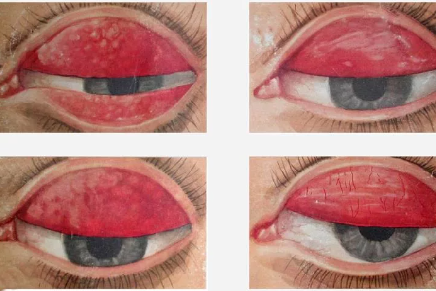 Трахома, симптомы и лечение трахомы