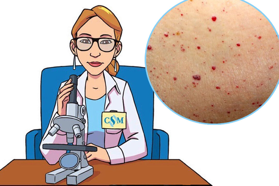 Красные родинки - на самом деле не родинки вовсе, а ангиомы